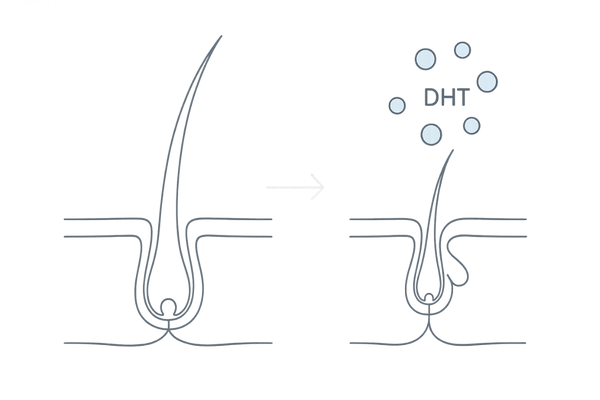 AGAでDHTが毛包に作用しヘアサイクルが短縮するメカニズム図