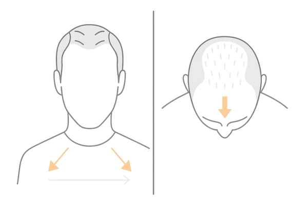 男性型脱毛症の進行パターン(M字はげ・O字はげ)の図解イメージ