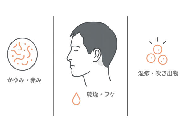 ミノキシジルによる肌荒れ症状の種類をまとめたイラスト図