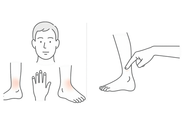 ミノタブによる顔・手足のむくみ症状と圧痕性浮腫セルフチェック