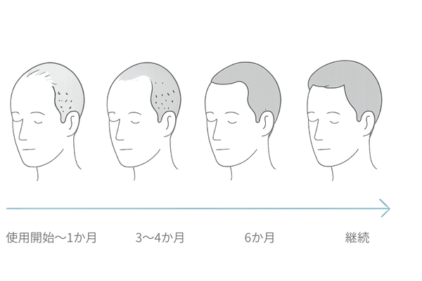 市販ミノキシジル使用開始から6か月までの変化を示すタイムラインイラスト