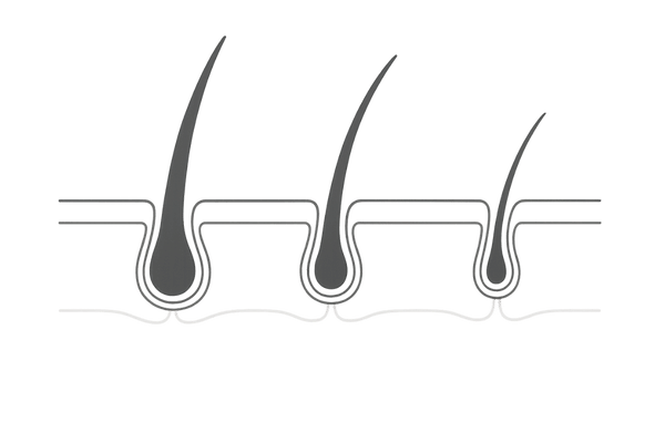 生え際の軟毛化による髪の細りを説明するイメージ図