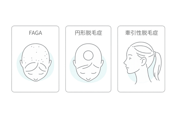 FAGAと他の脱毛症の比較図(FAGA/円形脱毛症/牽引性脱毛症のパターン違い)