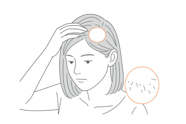 女性の円形脱毛症のサイン｜十円ハゲの境界がはっきりした脱毛斑イメージ