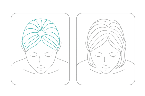 女性のつむじ薄毛|正常と薄毛の見分け方