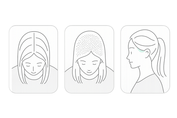 女性の薄毛タイプ比較(びまん性・FAGA・牽引性)|女性の薄毛 改善 図解