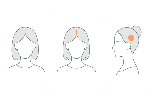 女性の薄毛の原因と種類を俯瞰できる比較図（びまん性脱毛症・FAGA・その他の脱毛症）