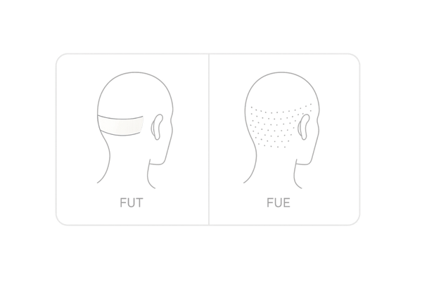 FUT法とFUE法の違い|女性の自毛植毛における採取法比較