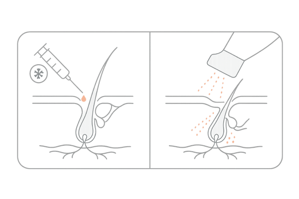 女性の薄毛治療メソセラピーの仕組み|頭皮への直接注入とノーニードルの比較図