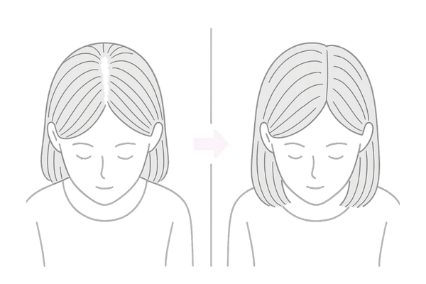女性のびまん性薄毛(FAGA)の改善イメージ|頭頂部のビフォー・アフター比較