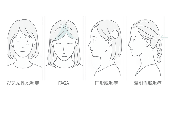 女性の薄毛タイプ比較|びまん性・FAGA・円形・牽引性の見た目イメージ