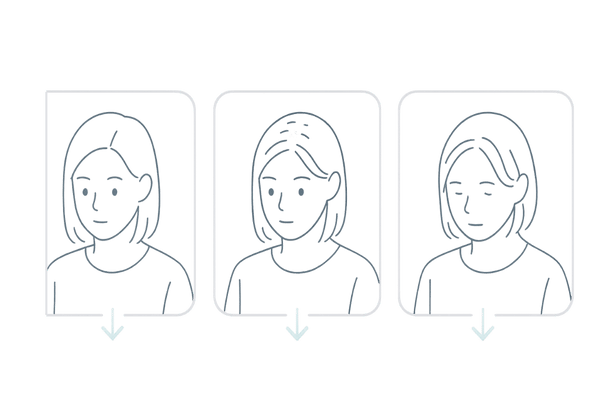女性の薄毛進行度イメージ|初期・中期・後期の見た目パターン比較