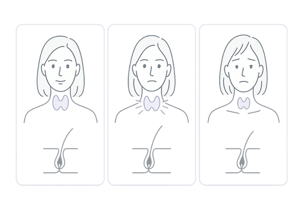 甲状腺機能（正常・亢進・低下）と髪の変化の比較イラスト｜女性のびまん性脱毛