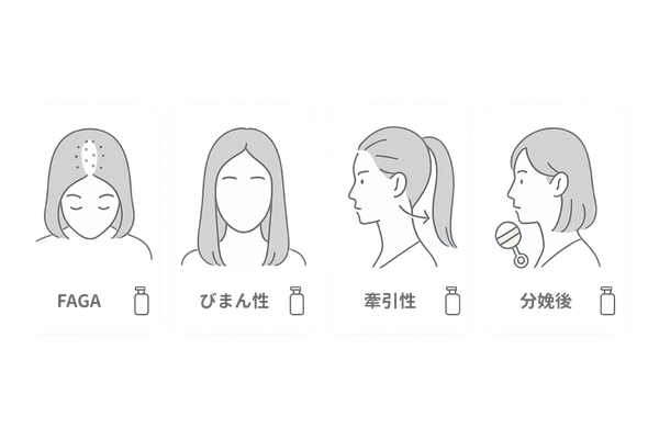 女性の薄毛の原因とタイプをひと目で比較(FAGA・びまん性・牽引性・分娩後)
