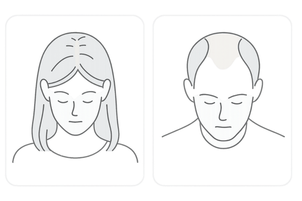 女性と男性の薄毛の違い|びまん性脱毛とAGA進行パターンの比較イラスト