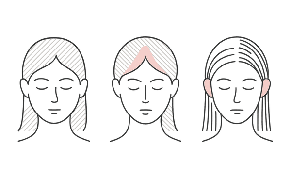 びまん性・FAGA・牽引性脱毛症を比較する女性頭部イラスト