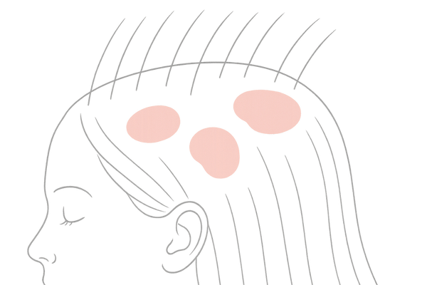 赤みやフケが見られる頭皮の拡大図