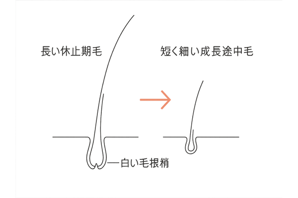 長く太い休止期毛と短い細毛の違い
