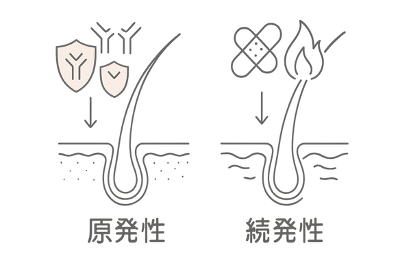 原発性と続発性瘢痕性脱毛症の違いを示す2つの頭皮イラスト