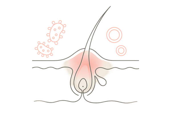 細菌と真菌が毛包を取り囲み炎症を起こしているイラスト