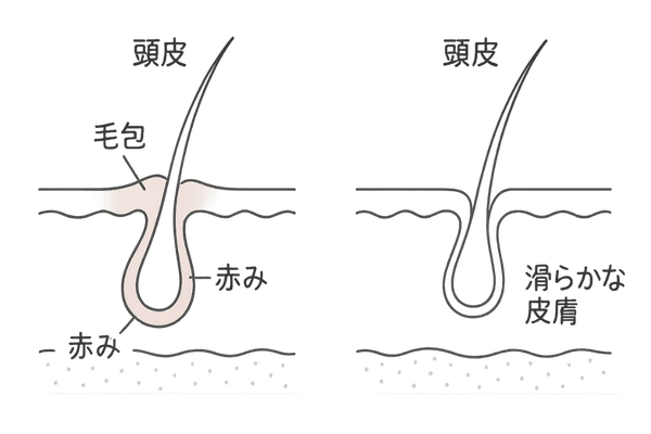 活動期と慢性期の頭皮断面図比較