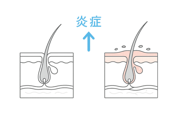 頭皮炎症 赤みとかゆみサインイラスト