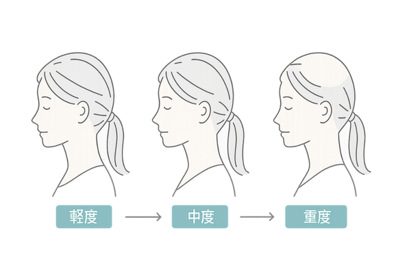 進行度別 軽度-中度-重度の脱毛段階イラスト