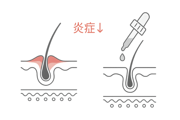 ステロイド外用薬で頭皮炎症を鎮めるイラスト