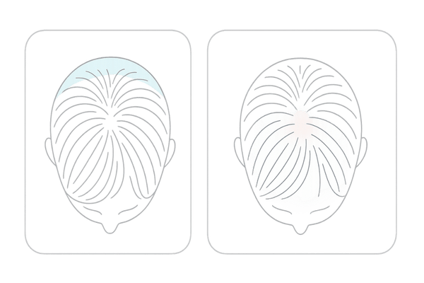 20代女性のつむじ薄毛セルフチェック|正常なつむじと薄毛サインのビジュアル比較