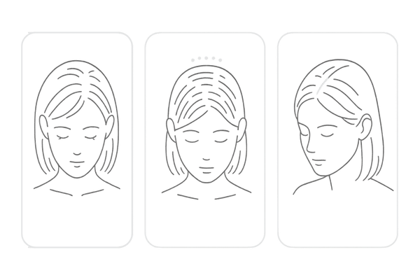 FAGA・びまん性・牽引性の違い|20代女性のつむじ薄毛につながる脱毛症タイプ比較