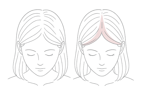 びまん性とFAGAパターンを比較する頭頂部イラスト
