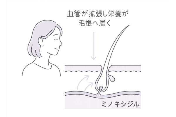 ミノキシジルが頭皮血流を改善して発毛を促す仕組みの図解