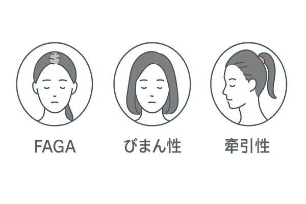 女性薄毛タイプ別特徴図 FAGA・びまん性・牽引性