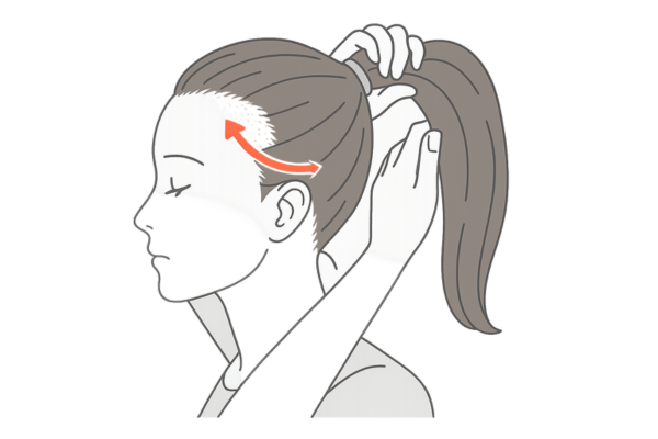 牽引性脱毛で後退する生え際ときついポニーテール