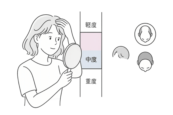 薄毛進行度セルフチェック―軽度・中度・重度スケール