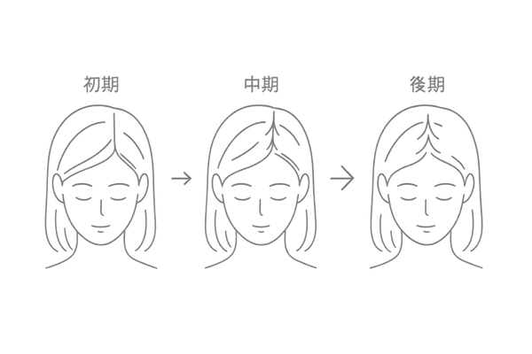 女性のFAGAの進行と分け目の変化