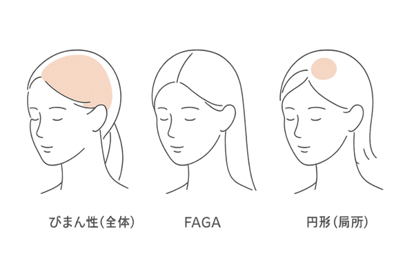 脱毛症タイプ別の比較図(びまん性・FAGA・円形)