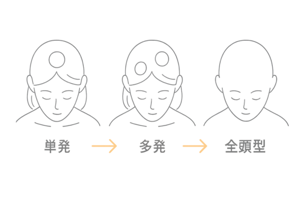 円形脱毛症の種類別イメージ