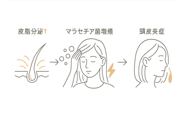 脂漏性脱毛症の原因フロー