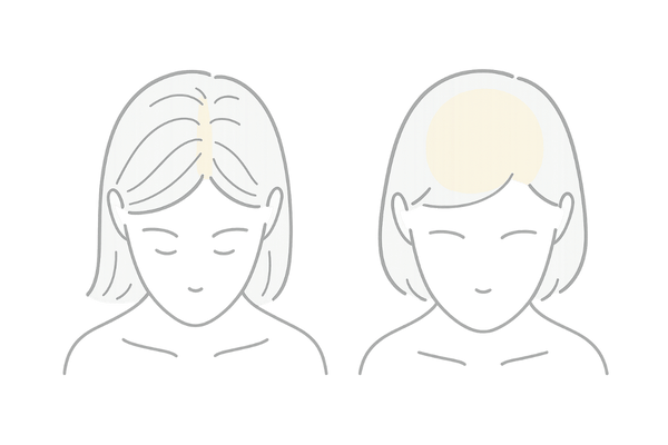 FAGAとびまん性脱毛症の違い|女性の薄毛パターン比較イラスト(頭頂部・全体の薄毛)