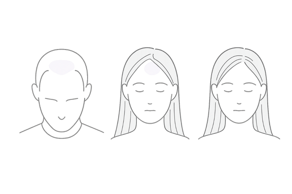 女性のM字はげとFAGA・男性AGAの進行パターン比較図（生え際の違い）

プロンプト