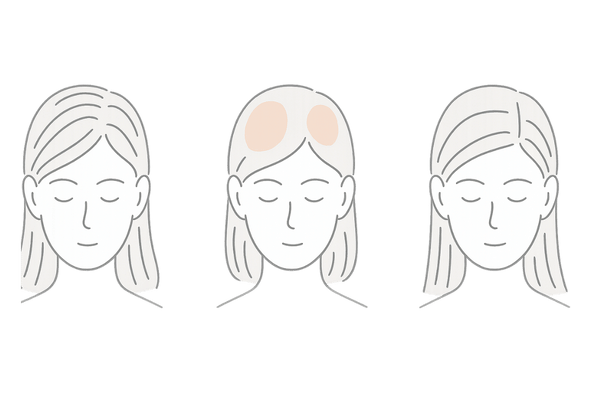 つむじハゲと他の脱毛症の違い比較|FAGA・円形・牽引の分布イメージ