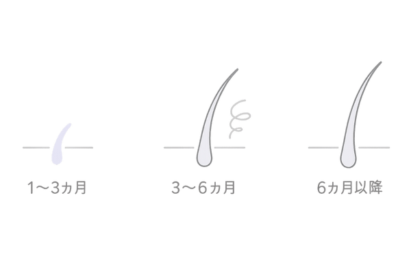 ミノキシジル5mgの効果タイムライン｜1〜6ヶ月で起こりやすい変化