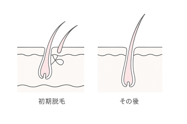 女性薄毛｜ミノキシジル初期脱毛の仕組み（新生毛が古い毛を押し出すイメージ）