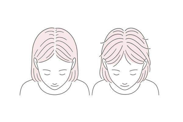 女性薄毛｜ミノキシジルで変わる分け目と産毛の増加（ビフォーアフター）