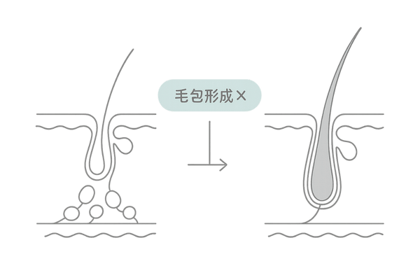脂腺母斑で毛包が欠損した頭皮断面図