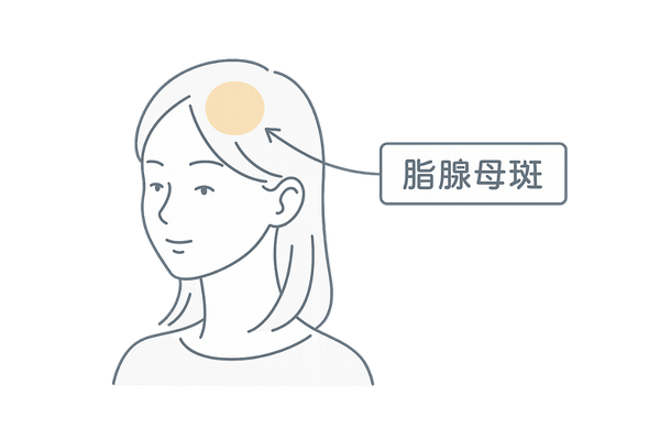 典型的な脂腺母斑の黄色い脱毛斑イメージ