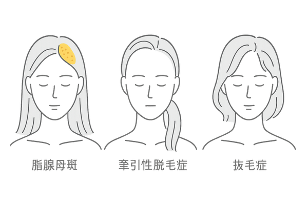 牽引性・抜毛症との違い（3タイプ並列）