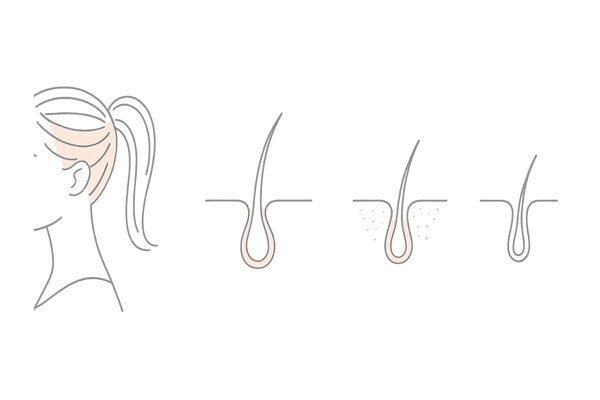 ポニーテールで生じる牽引力と生え際ダメージの仕組み｜牽引性脱毛症のメカニズム図