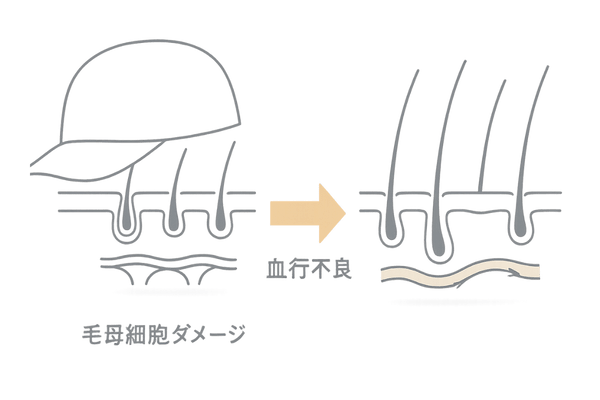 圧迫性脱毛症 頭皮圧迫と血行不良の解説イラスト